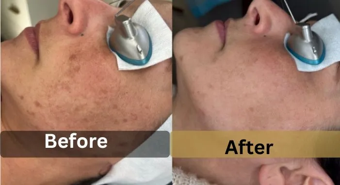 Aerolase laser before and after results showing clearer skin and reduced acne and pigmentation at Strella Medical Aesthetics