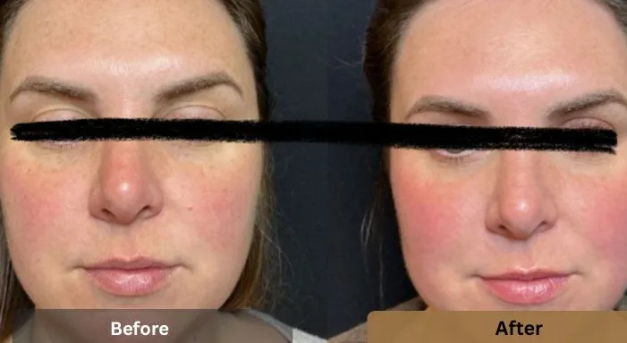 Before and after results of BBL and MOXI treatment showing improved skin tone, reduced redness, and smoother complexion at Strella Medical Aesthetics