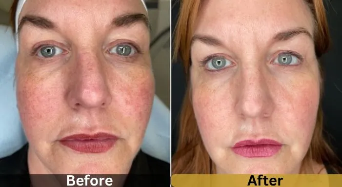 ad Band Light (BBL) before and after showing reduction in rosacea redness and visible vessels after one treatment at Strella Medical Aesthetics in Lower Gwynedd PA