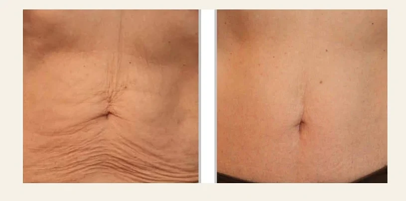 Before and after skin tightening treatment showing improved neck and jawline firmness with reduced loose skin at Strella Medical Aesthetics in Lower Gwynedd, PA