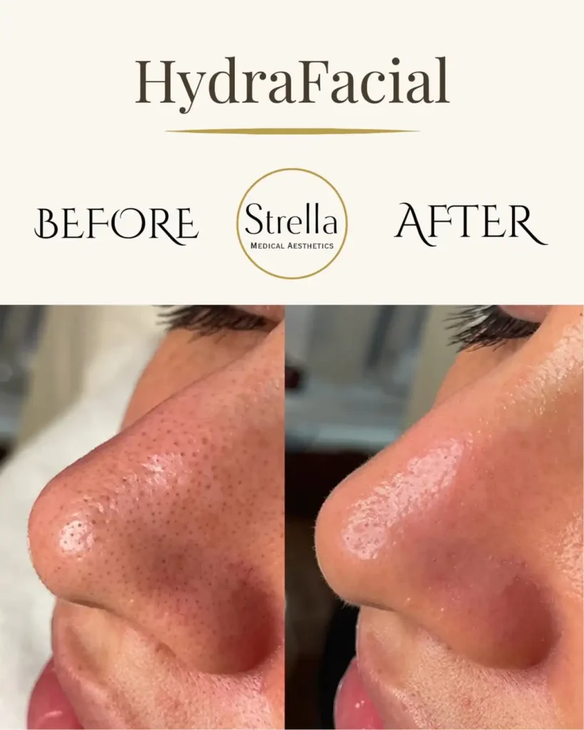 HydraFacial before and after showing reduced pore congestion and cleaner-looking pores on the nose at Strella Medical Aesthetics near King of Prussia, PA.