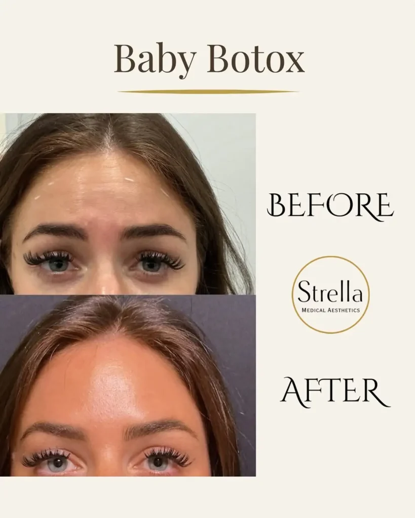 Baby Botox before and after at Strella Medical Aesthetics