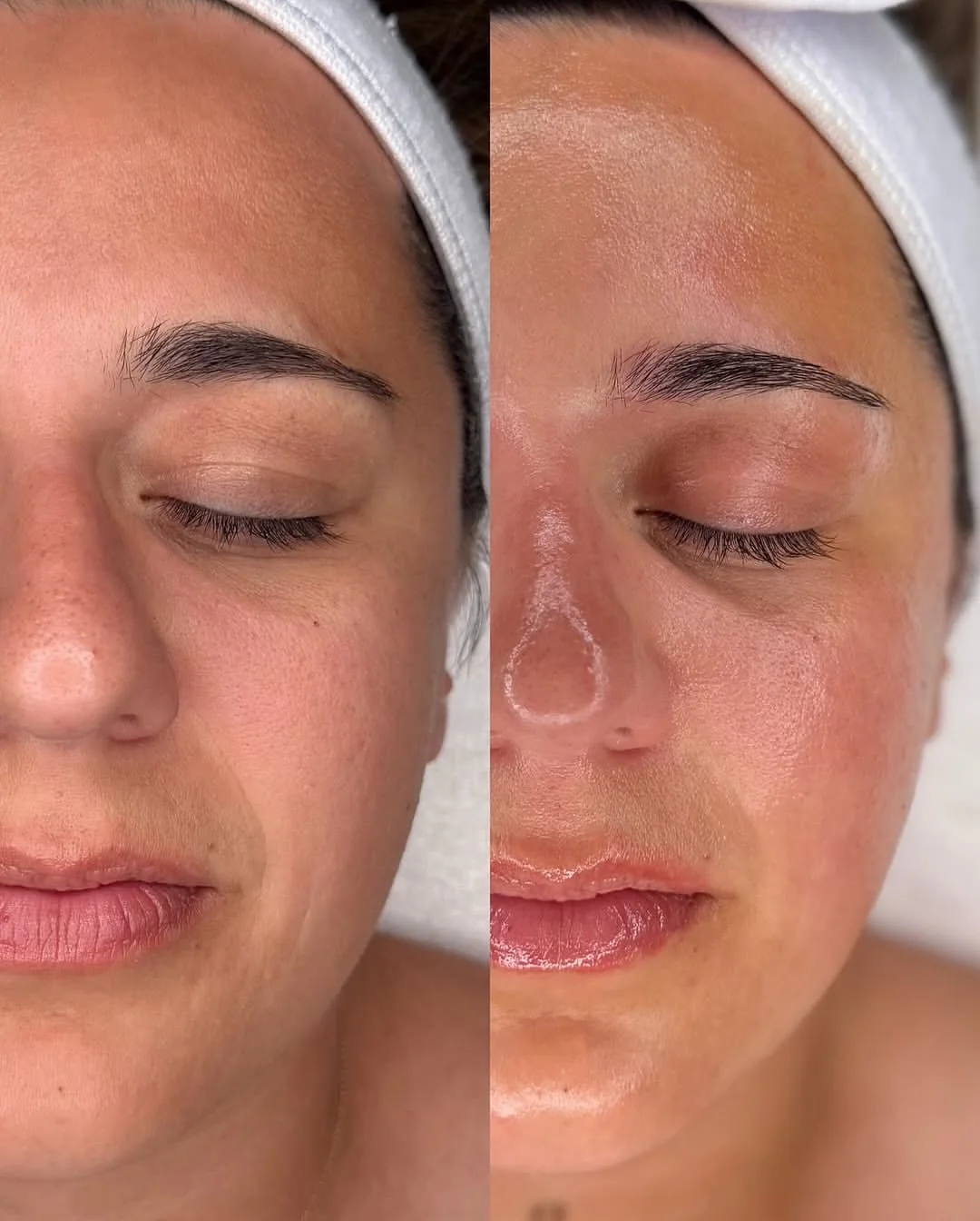 Woman receiving a professional HydraFacial treatment.