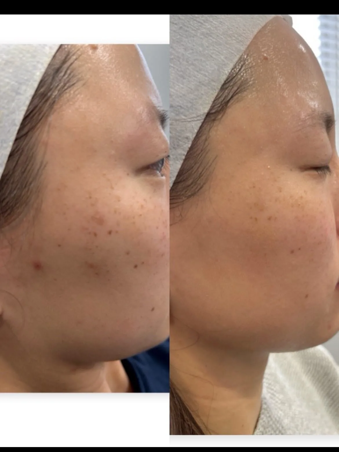 Before and after SkinPen microneedling treatment showing improvement in acne scars and smoother skin at Strella Medical Aesthetics in Trooper, PA.