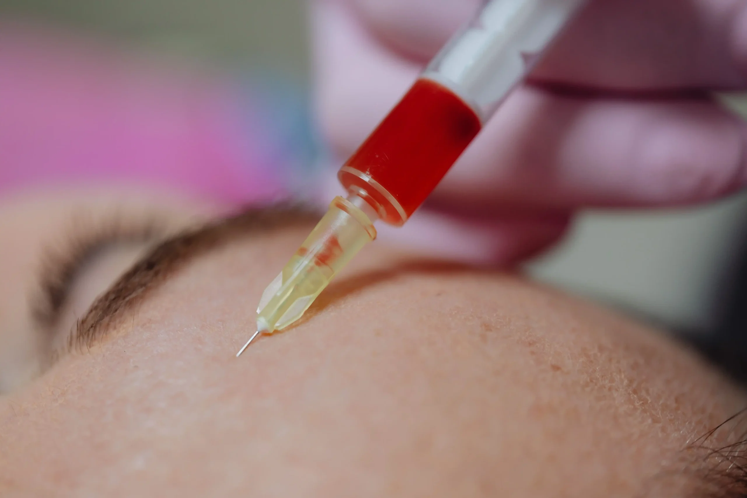 PRP treatment injection being performed on facial skin