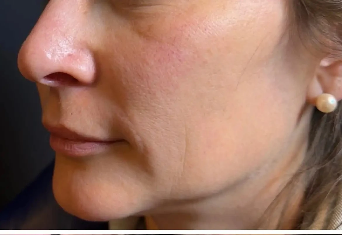 Sculptra facial rejuvenation for gradual collagen support in Montgomery County PA